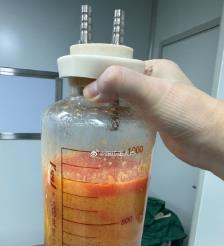 楚雄水动力吸脂手术要做多久？